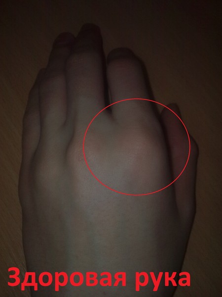 Как и чем лечить ушиб на костяшке руки?